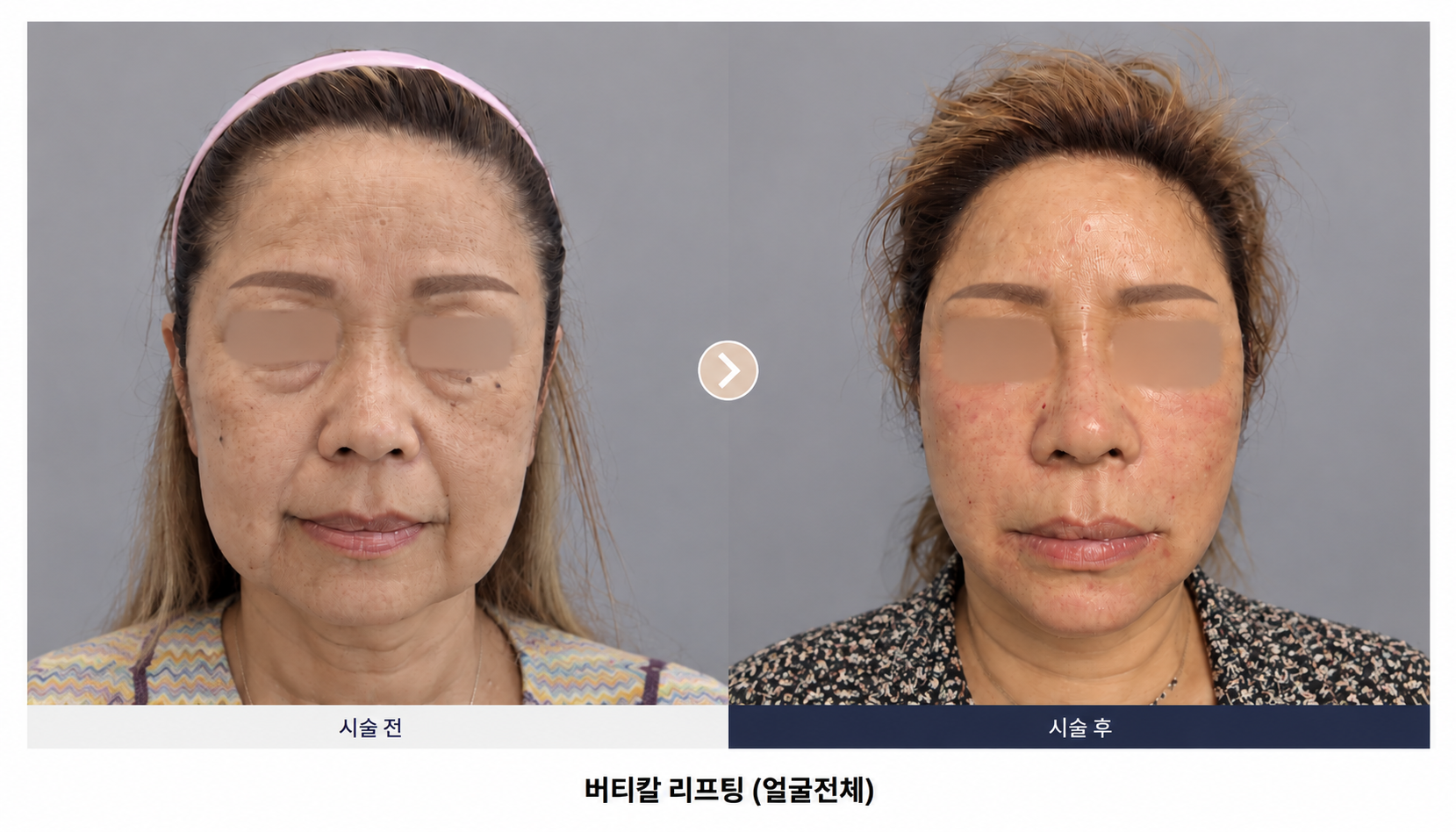 안면수직 리프팅 비포·애프터 합본 사진 1
