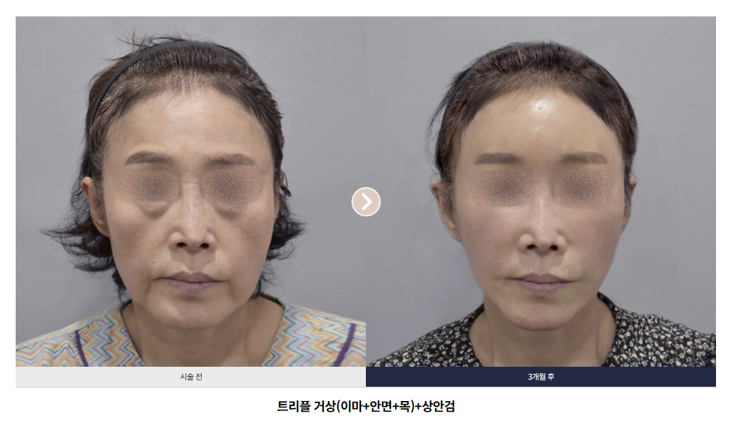 안면수직 리프팅 비포·애프터 합본 사진 2